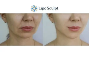 Explaining Total Skin Tightening Treatment And What It Can Do For You 2 Do you want to boost your self confidence? Give Morpheus8 Sale a try today!