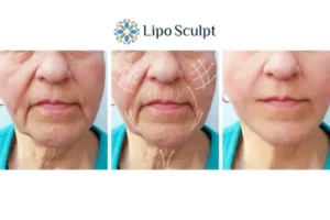 Explaining Total Skin Tightening Treatment And What It Can Do For You 3 Boost your confidence with Morpheus8 Sale call our team today!