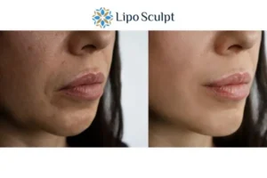Explaining Total Skin Tightening Treatment And What It Can Do For You 4 Morpheus8 Sale the best results - call our team today!
