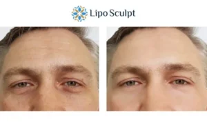 Explaining Total Skin Tightening Treatment And What It Can Do For You 6 Morpheus8 Sale book in today to find out more!