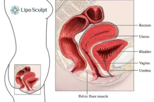 Treatment For A Leaky Bladder 2 How EM Chair treatment Sale can help Leaky bladder issues. Read more now!