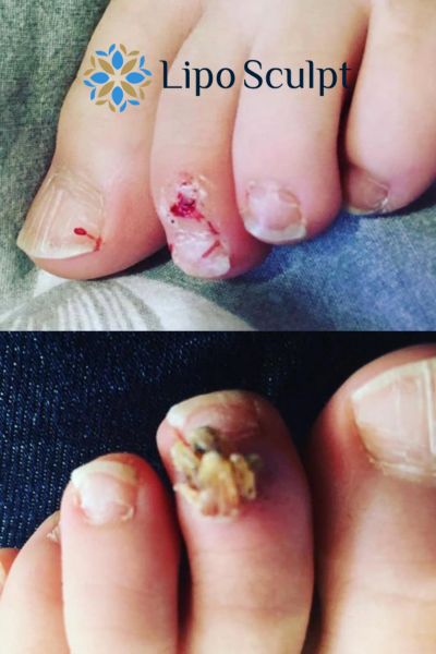 Wart removal customer results from Lipo Sculpt Sale
